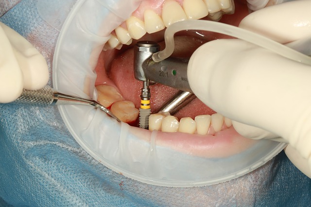 jak se vsazuje zubní implantát